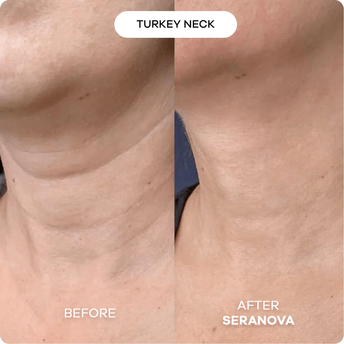 The Micro Infusion System™